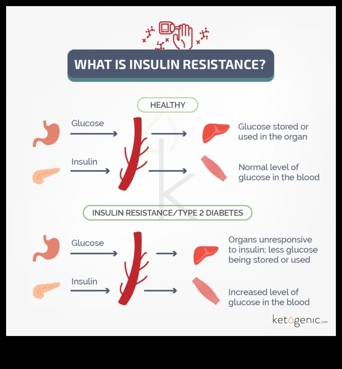 Κέτο και ευαισθησία στην ινσουλίνη: Πλοήγηση στη σχέση